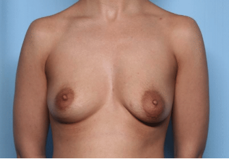 Breast Lift with Implant Before & After Patient #34302